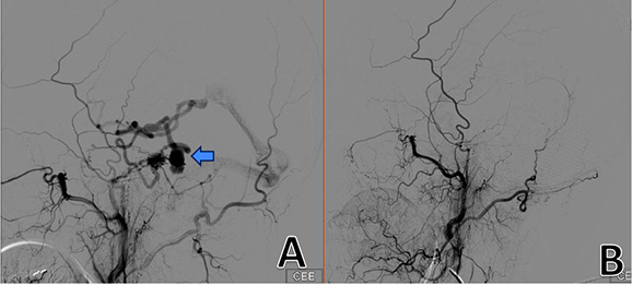 [There is a picture of cerebral angiogram, visualizing all the brain vessels, showing a lesion, marked by the arrow on the left. On the right side of the image, there is a postoperative cerebral aniogram, in which the previously seen lesion has been removed and is no longer visible.]