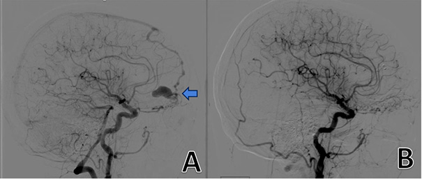 [There is a picture of cerebral angiogram, visualizing all the brain vessels, showing a lesion, marked by the arrow on the left. On the right side of the image, there is a postoperative cerebral aniogram, in which, the previously seen lesion has been removed and is no longer visible.]