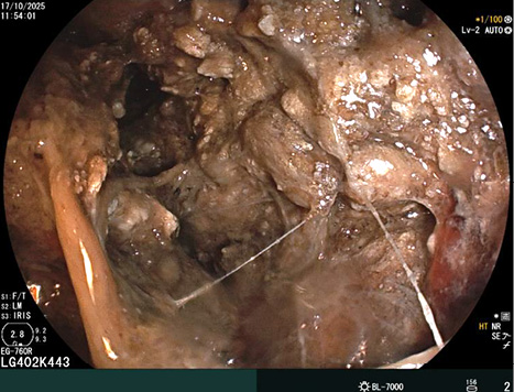 [The endoscope is introduced into the epigastric sac through the rounded opening of the greater curvature of the stomach. The photo shows a large focus of necrotic pancreatic masses, dark brown and black in color. All visible pancreatic tissue is necrotized].

