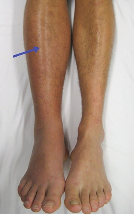 A man's feet with a blue line pointing to the right leg.
Description generated by AI