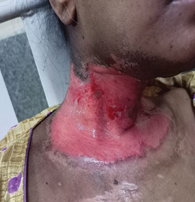 A woman with a red and white burn on her neck.
Description generated by AI