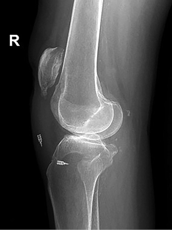 A leg with a broken knee cap.
Description generated by AI