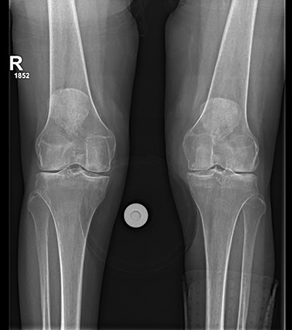 A knee with a metal screw in it.
Description generated by AI
