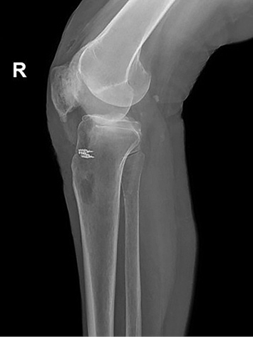 A leg with a metal pin in it.
Description generated by AI