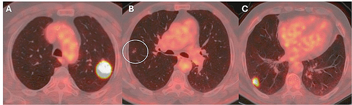 Three images of a lung with red and orange spots.
Description generated by AI