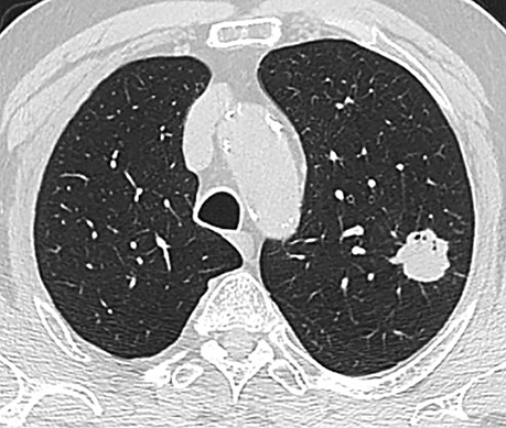 A black and white image of a lung.
Description generated by AI
